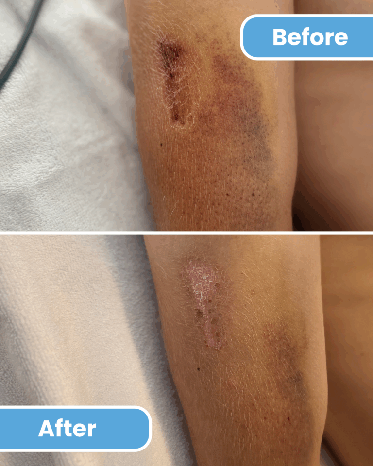 Before and after Nano CellCare treatment on sports injury arm showing faster wound and bruise recovery